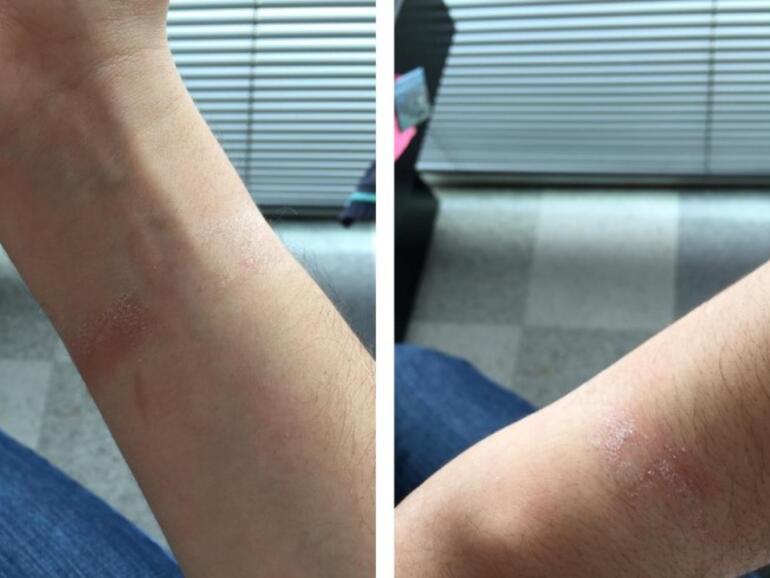 Hautirritationen aufgrund der Apple Watch