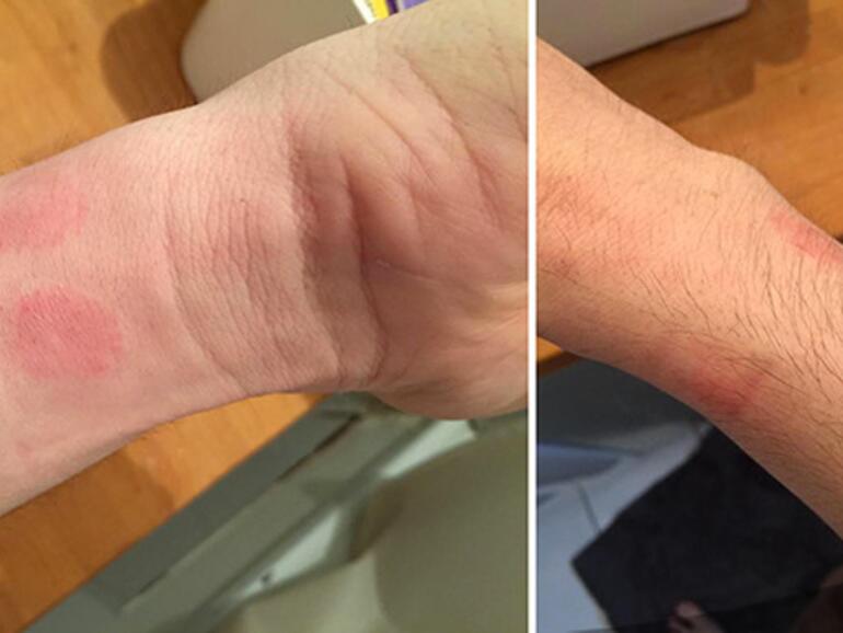 Hautirritationen aufgrund der Apple Watch