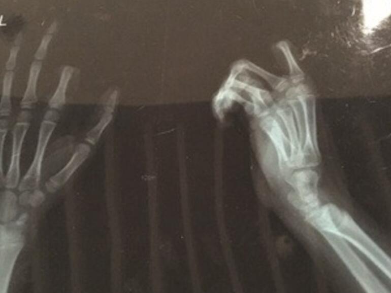 Da fehlt ein Stück vom linken Zeigefinger