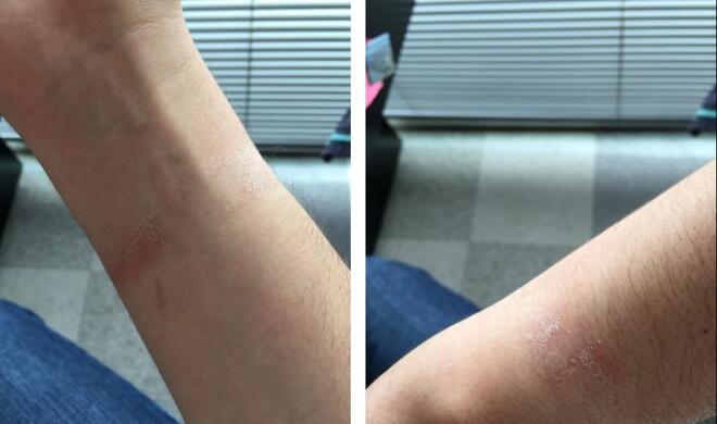 Hautirritationen aufgrund der Apple Watch