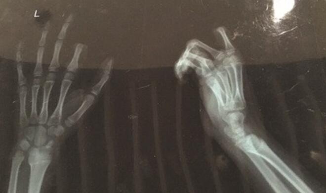 Da fehlt ein Stück vom rechten Zeigefinger